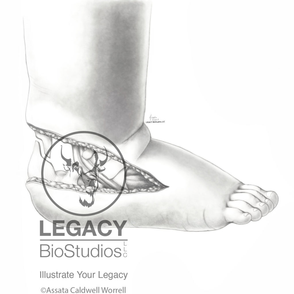Lateral View of Clubfoot Surgery